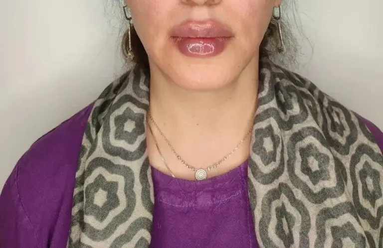 تزریق ژل- کاماپرس