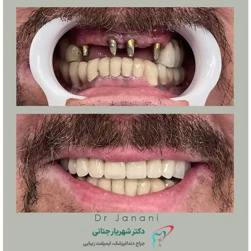 هزینه ایمپلنت دندان در کرج - کاماپرس