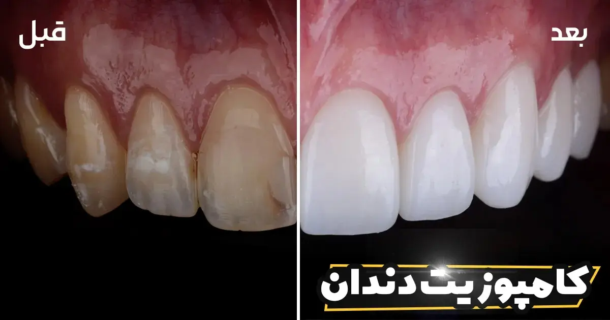 ایمپلنت دندان - کاماپرس