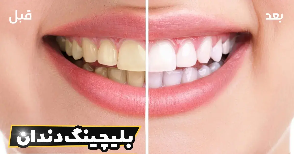 ایمپلنت دندان - کاماپرس