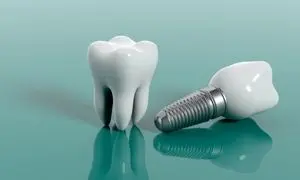 ایمپلنت دندان اقساطی در کرج با دکتر شهریار جنانی