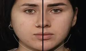 بوکال فت در اصفهان؛ روش محبوب زاویه‌ سازی صورت بدون نیاز به جراحی سنگین