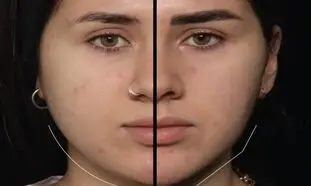 بوکال فت در اصفهان؛ روش محبوب زاویه‌ سازی صورت بدون نیاز به جراحی سنگین