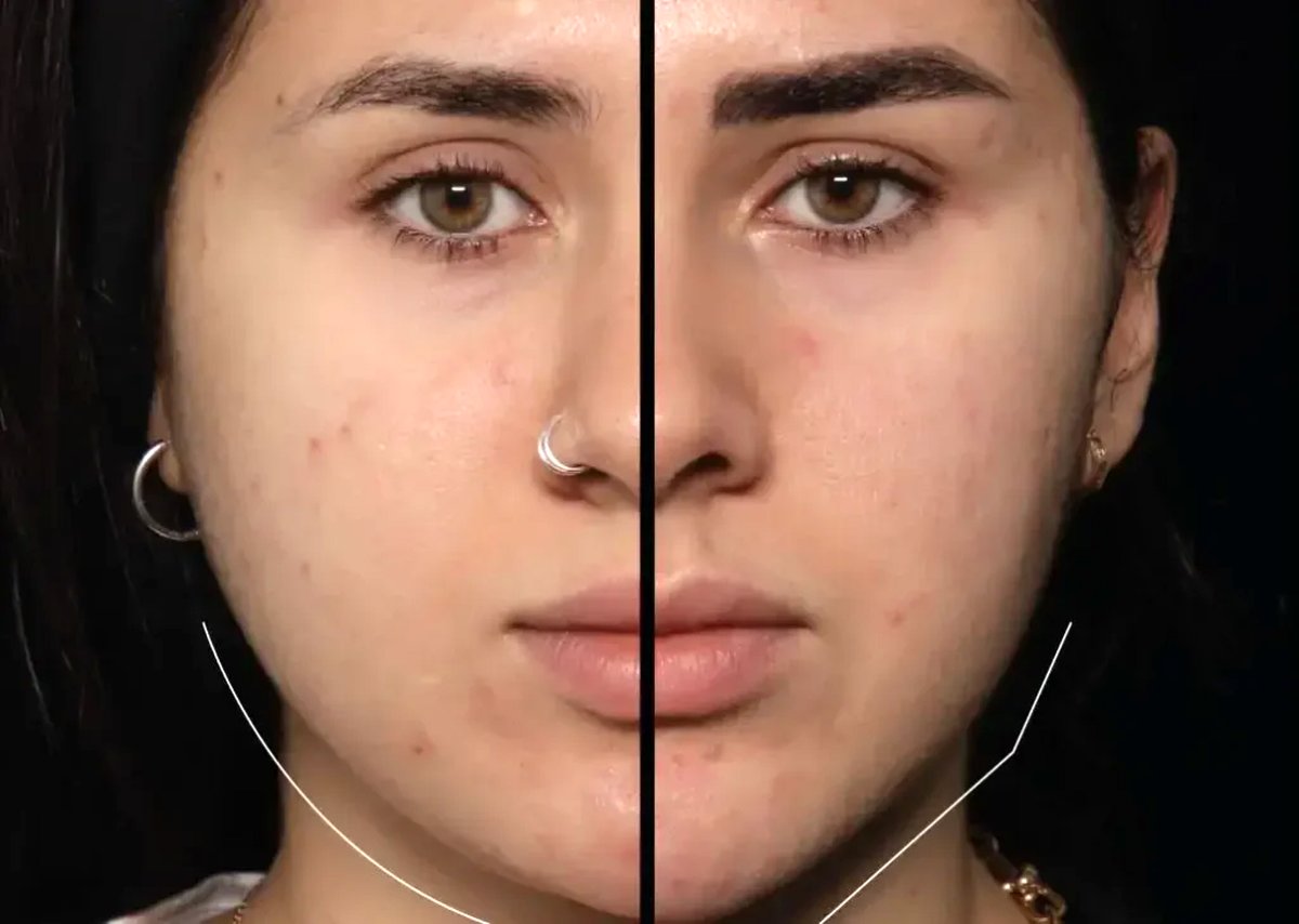 بوکال فت در اصفهان؛ روش محبوب زاویه‌ سازی صورت بدون نیاز به جراحی سنگین
