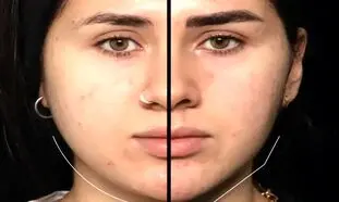 بوکال فت در اصفهان؛ روش محبوب زاویه‌ سازی صورت بدون نیاز به جراحی سنگین