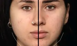 بوکال فت در اصفهان؛ روش محبوب زاویه‌ سازی صورت بدون نیاز به جراحی سنگین