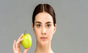 ۵ ماده غذایی مضر که باعث ایجاد جوش و آکنه می‌شود