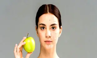 ۵ ماده غذایی مضر که باعث ایجاد جوش و آکنه می‌شود