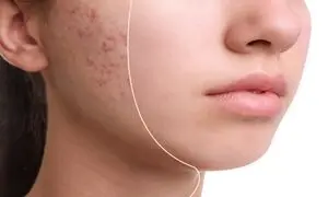 ۴ کرم ضدجوش و آکنه مخصوص پوست مختلط + قیمت