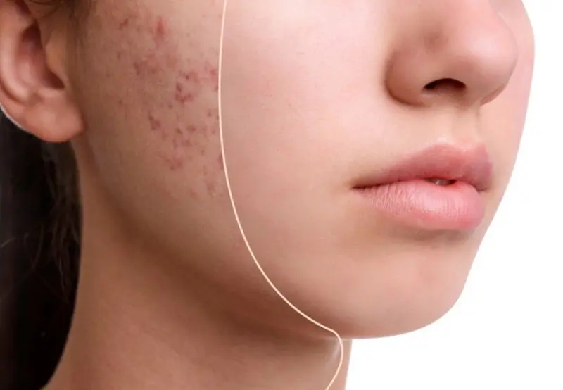 ۴ کرم ضدجوش و آکنه مخصوص پوست مختلط + قیمت