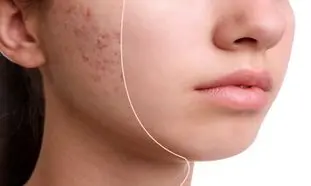 ۴ کرم ضدجوش و آکنه مخصوص پوست مختلط + قیمت