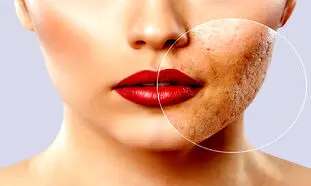 ۴ کرم ضدجوش و آکنه موثر برای پوست صورت + قیمت