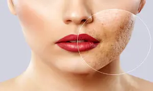 ۴ کرم ضدجوش و آکنه موثر برای پوست صورت + قیمت