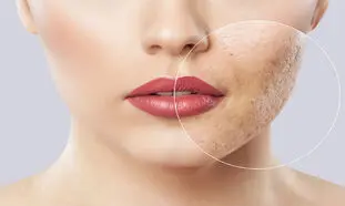 ۴ کرم ضدجوش و آکنه موثر برای پوست صورت + قیمت