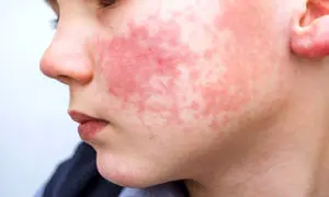 تمام آنچه باید درباره بیماری مرموز سندرم DRESS بدانید