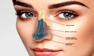 مزایای جراحی طبیعی بینی استخوانی چیست؟