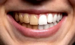 مؤثرترین خمیردندان سفیدکننده برای افراد سیگاری