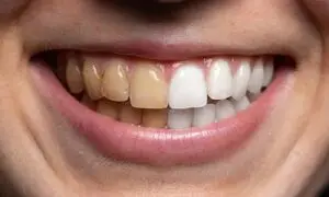 مؤثرترین خمیردندان سفیدکننده برای افراد سیگاری