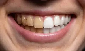 مؤثرترین خمیردندان سفیدکننده برای افراد سیگاری