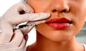 تزریق ژل لب و همه چیز درباره آن