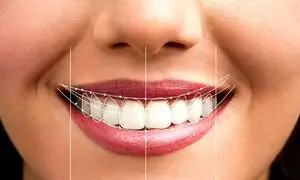 چطور یک لبخند زیبا داشته باشیم؟