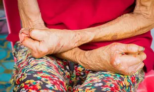 افزایش دلهره‌ آور آمار جذام در آمریکا