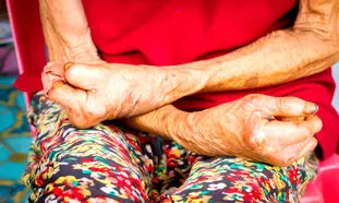 افزایش دلهره‌ آور آمار جذام در آمریکا