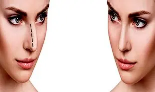 قابل توجه متقاضیان جراحی بینی استخوانی
