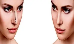 قابل توجه متقاضیان جراحی بینی استخوانی