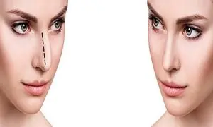 قابل توجه متقاضیان جراحی بینی استخوانی