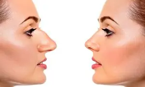 بهترین مدل عمل بینی در سال 1402