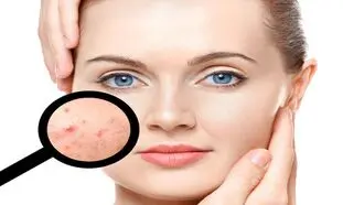 ۵ کرم ضدجوش ارزان در بازار  + قیمت
