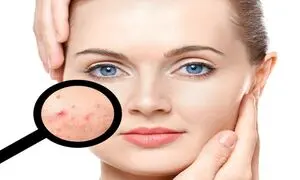۵ کرم ضدجوش ارزان در بازار  + قیمت