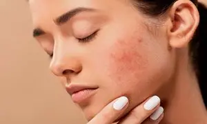 پرفروش ترین محصول برای رفع جوش زیر پوستی + قیمت
