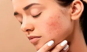 پرفروش ترین محصول برای رفع جوش زیر پوستی + قیمت