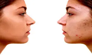 5 کرم ضدجوش صورت با قیمت زیر 300 هزار تومان
