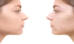 5 کرم ضدجوش صورت با قیمت زیر 300 هزار تومان