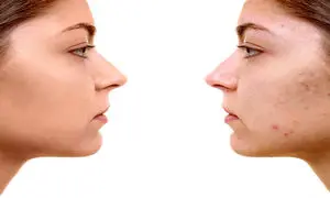 5 کرم ضدجوش صورت با قیمت زیر 300 هزار تومان