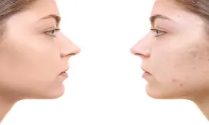 5 کرم ضدجوش صورت با قیمت زیر 300 هزار تومان
