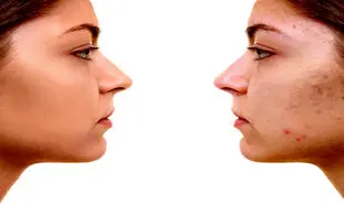 5 کرم ضدجوش صورت با قیمت زیر 300 هزار تومان