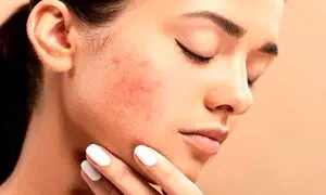 4 روتین کلیدی پوست چرب در روزهای گرم تابستان
