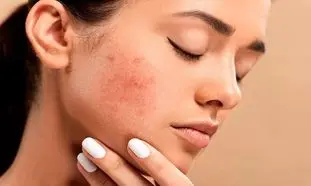 4 روتین کلیدی پوست چرب در روزهای گرم تابستان