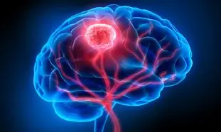 انواع تومور مغزی و علائم و راه های درمان
