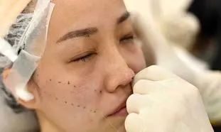 5 نکته مهم درباره مزایا و هزینه لیفت صورت با نخ در اصفهان