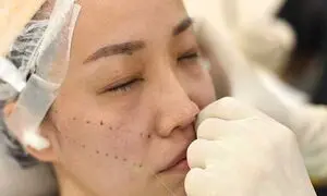 5 نکته مهم درباره مزایا و هزینه لیفت صورت با نخ در اصفهان