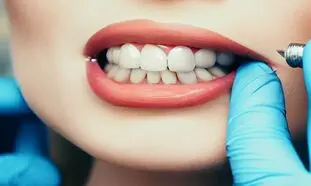 هزینه ایمپلنت دندان در ایران و مقایسه آن با سایر کشورها