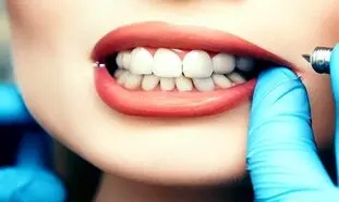 هزینه ایمپلنت دندان در ایران و مقایسه آن با سایر کشورها