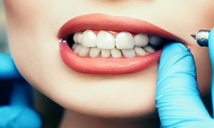 هزینه ایمپلنت دندان در ایران و مقایسه آن با سایر کشورها