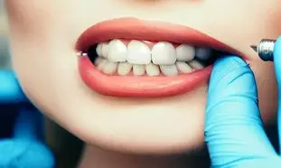 هزینه ایمپلنت دندان در ایران و مقایسه آن با سایر کشورها