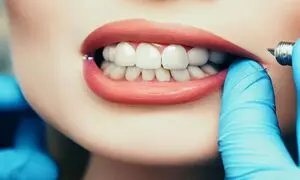هزینه ایمپلنت دندان در ایران و مقایسه آن با سایر کشورها